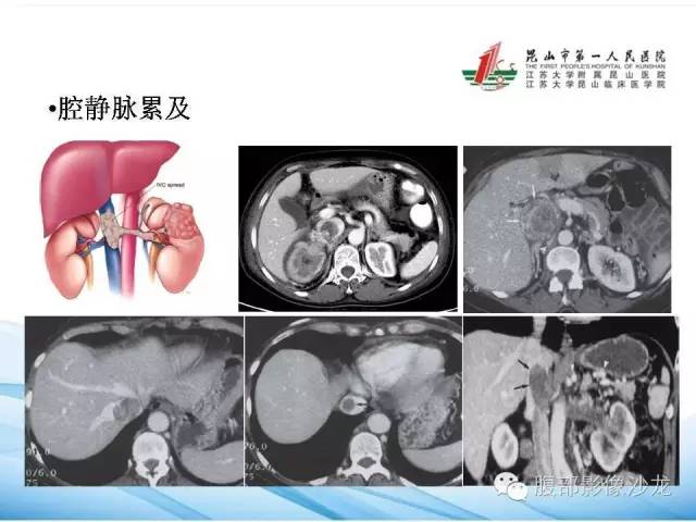 【PPT】透明细胞肾癌的诊断与鉴别