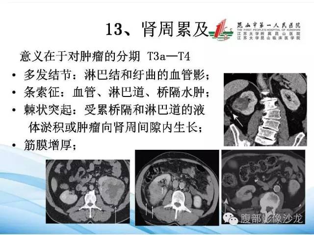 【PPT】透明细胞肾癌的诊断与鉴别
