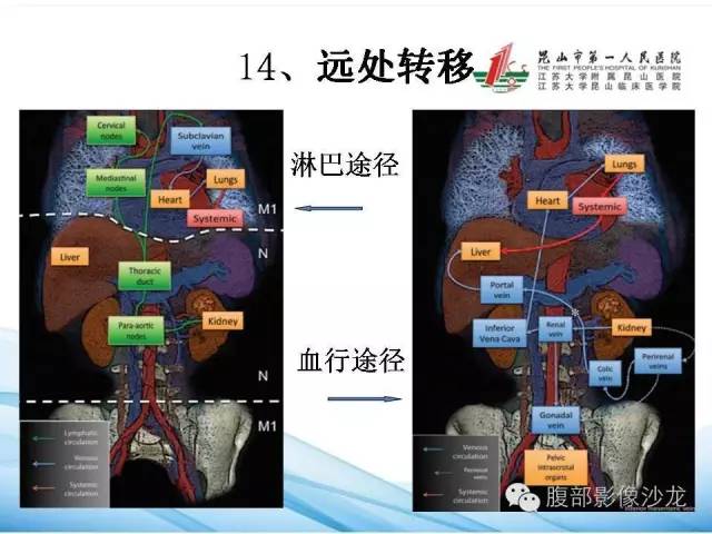 【PPT】透明细胞肾癌的诊断与鉴别