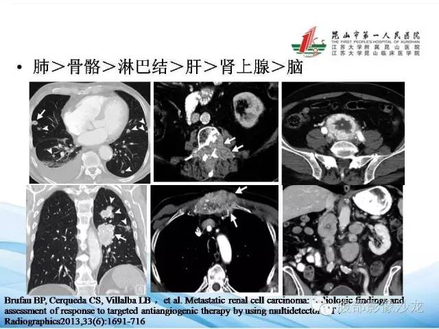 【PPT】透明细胞肾癌的诊断与鉴别