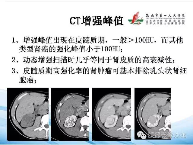 【PPT】透明细胞肾癌的诊断与鉴别