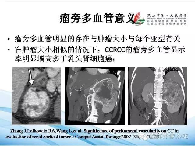 【PPT】透明细胞肾癌的诊断与鉴别