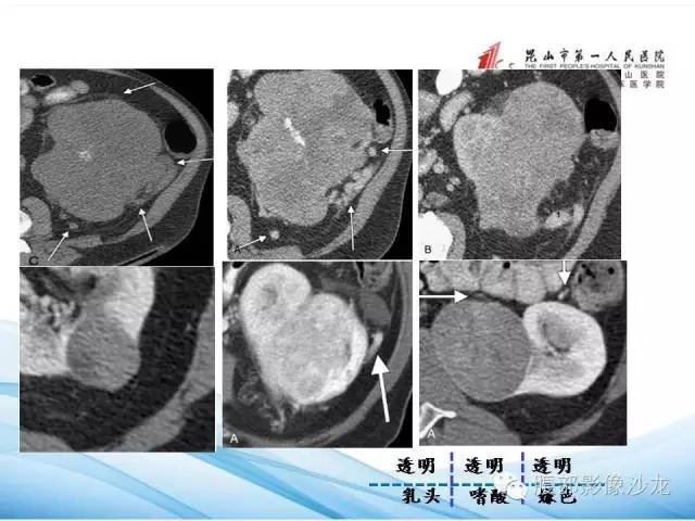 【PPT】透明细胞肾癌的诊断与鉴别