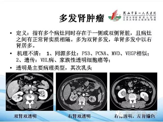 【PPT】透明细胞肾癌的诊断与鉴别