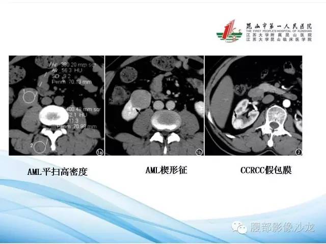 【PPT】透明细胞肾癌的诊断与鉴别