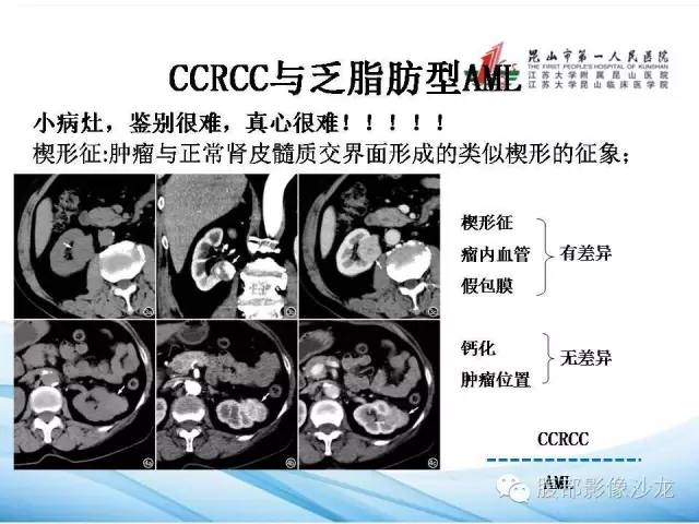 【PPT】透明细胞肾癌的诊断与鉴别