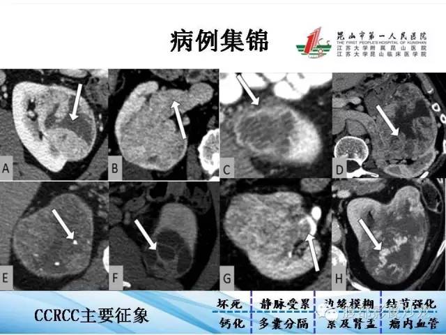 【PPT】透明细胞肾癌的诊断与鉴别