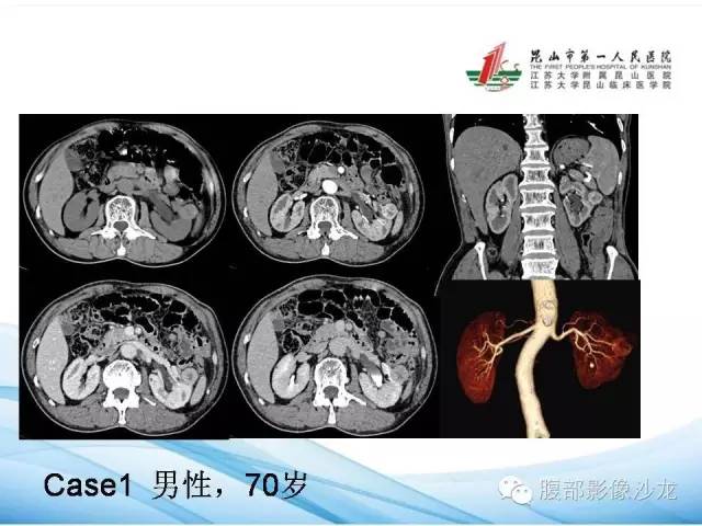 【PPT】透明细胞肾癌的诊断与鉴别