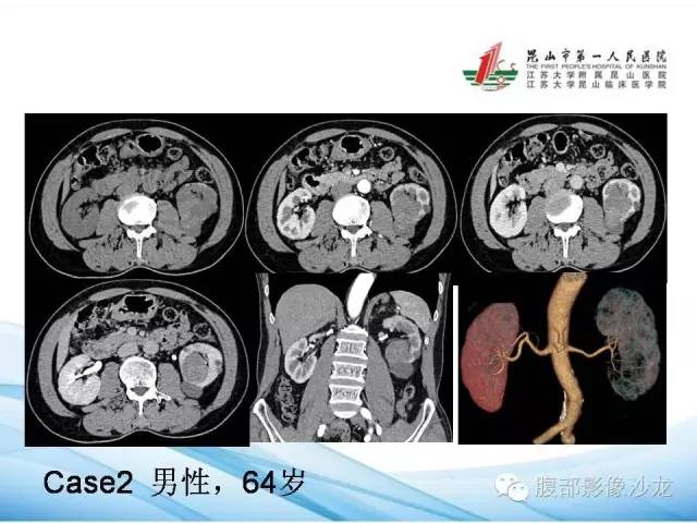 【PPT】透明细胞肾癌的诊断与鉴别