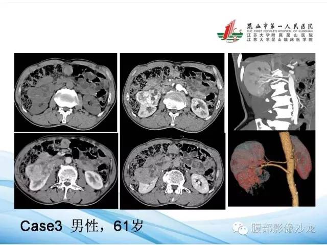 【PPT】透明细胞肾癌的诊断与鉴别