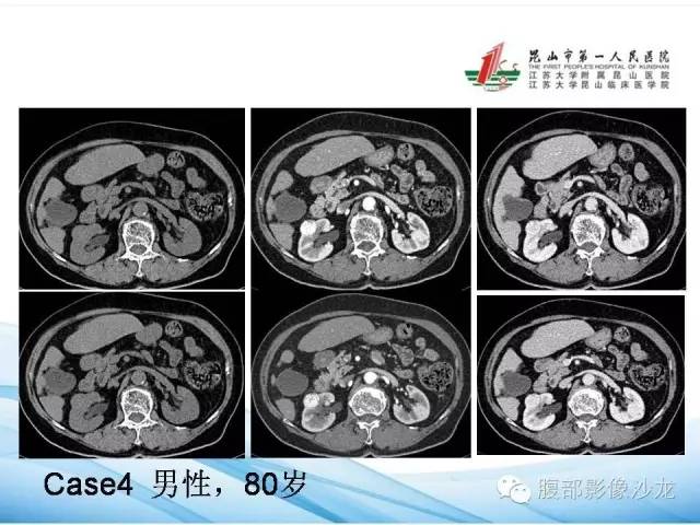 【PPT】透明细胞肾癌的诊断与鉴别