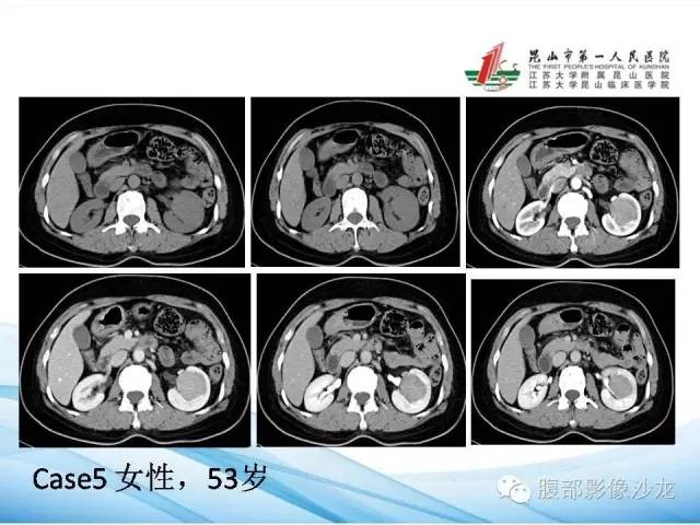 【PPT】透明细胞肾癌的诊断与鉴别