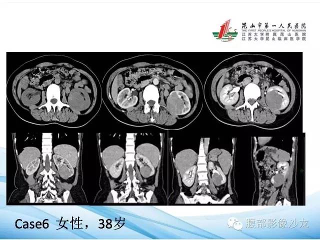 【PPT】透明细胞肾癌的诊断与鉴别