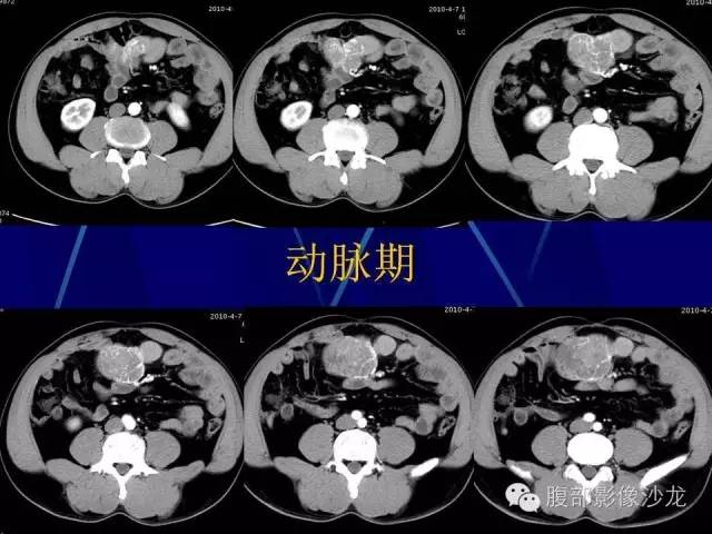 【病例】胃肠道间质瘤1例CT影像表现 【病例】胃肠道间质瘤1例CT影像表现