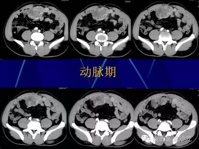 【病例】胃肠道间质瘤1例CT影像表现 【病例】胃肠道间质瘤1例CT影像表现