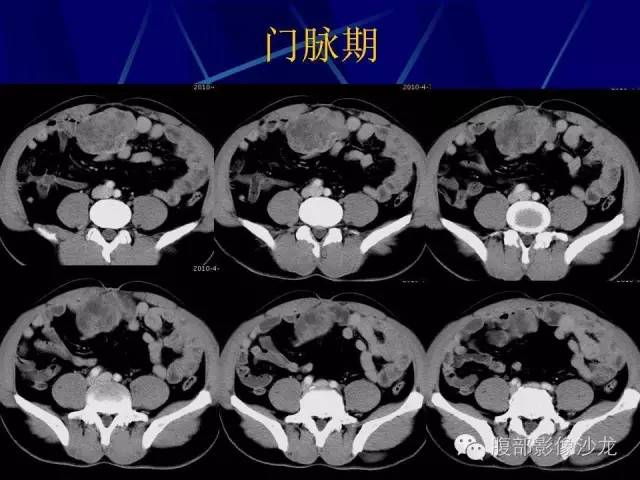 【病例】胃肠道间质瘤1例CT影像表现 【病例】胃肠道间质瘤1例CT影像表现