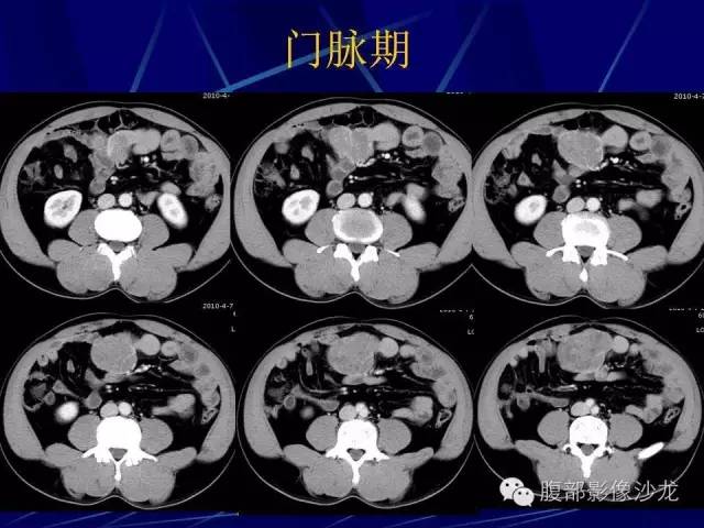 【病例】胃肠道间质瘤1例CT影像表现 【病例】胃肠道间质瘤1例CT影像表现