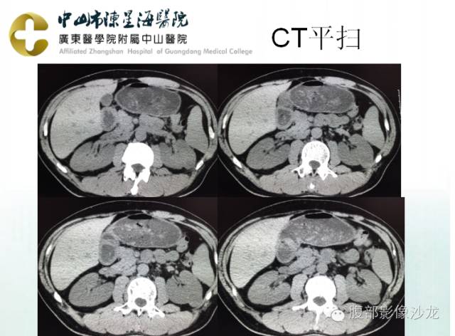 【病例】多房性囊性肾细胞癌1例CT及MR影像表现 【病例】多房性囊性肾细胞癌1例CT及MR影像表现