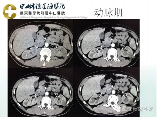 【病例】多房性囊性肾细胞癌1例CT及MR影像表现 【病例】多房性囊性肾细胞癌1例CT及MR影像表现
