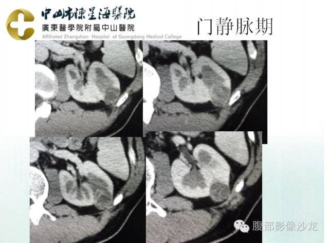【病例】多房性囊性肾细胞癌1例CT及MR影像表现 【病例】多房性囊性肾细胞癌1例CT及MR影像表现