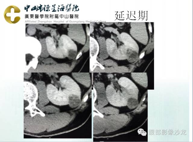 【病例】多房性囊性肾细胞癌1例CT及MR影像表现 【病例】多房性囊性肾细胞癌1例CT及MR影像表现