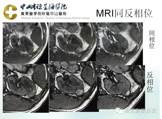【病例】多房性囊性肾细胞癌1例CT及MR影像表现 【病例】多房性囊性肾细胞癌1例CT及MR影像表现