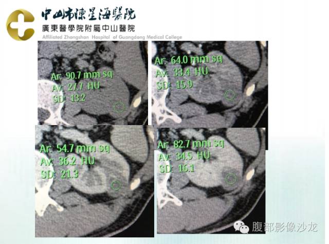 【病例】多房性囊性肾细胞癌1例CT及MR影像表现 【病例】多房性囊性肾细胞癌1例CT及MR影像表现