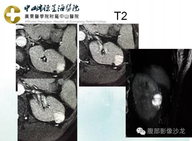 【病例】多房性囊性肾细胞癌1例CT及MR影像表现 【病例】多房性囊性肾细胞癌1例CT及MR影像表现
