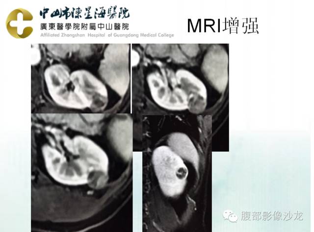 【病例】多房性囊性肾细胞癌1例CT及MR影像表现 【病例】多房性囊性肾细胞癌1例CT及MR影像表现