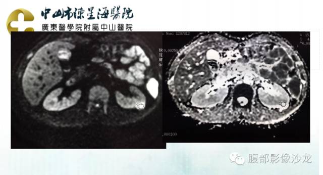 【病例】多房性囊性肾细胞癌1例CT及MR影像表现 【病例】多房性囊性肾细胞癌1例CT及MR影像表现