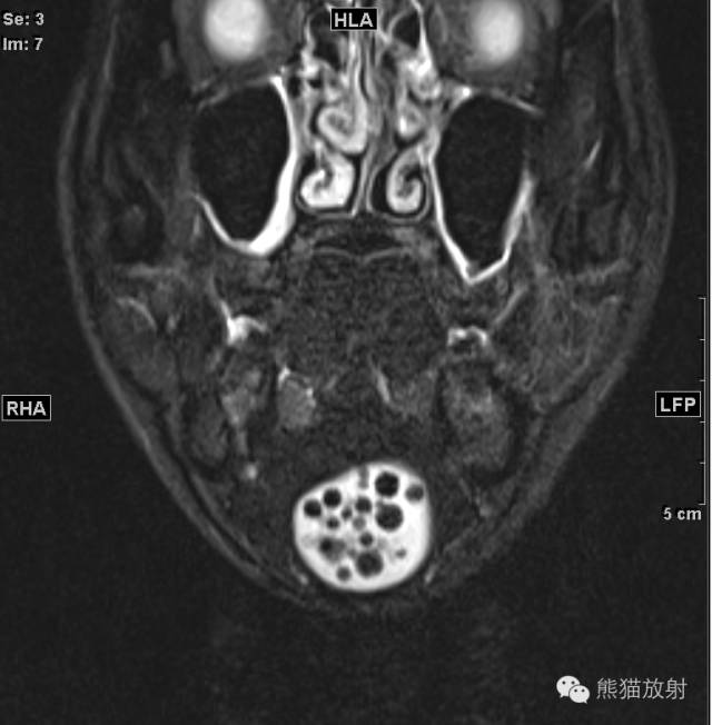 【病例】颌下区表皮样囊肿1例MR影像表现 【病例】颌下区表皮样囊肿1例MR影像表现