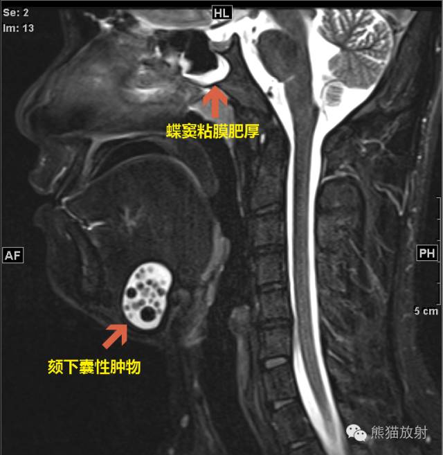 【病例】颌下区表皮样囊肿1例MR影像表现 【病例】颌下区表皮样囊肿1例MR影像表现