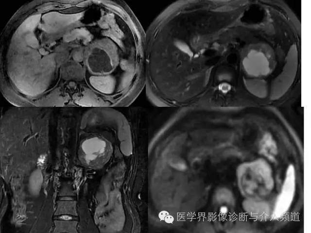 【病例】腹膜后神经鞘瘤2例MR影像表现