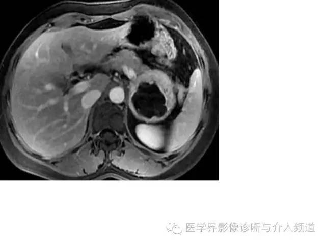 【病例】腹膜后神经鞘瘤2例MR影像表现