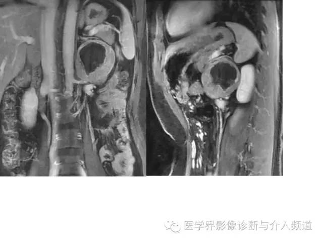 【病例】腹膜后神经鞘瘤2例MR影像表现