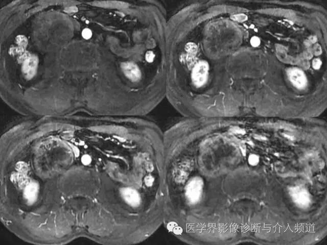 【病例】腹膜后神经鞘瘤2例MR影像表现