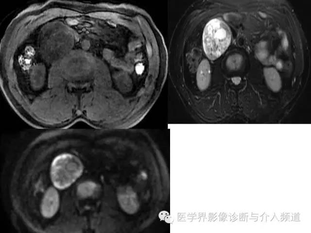 【病例】腹膜后神经鞘瘤2例MR影像表现