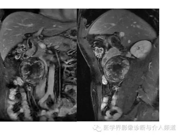 【病例】腹膜后神经鞘瘤2例MR影像表现