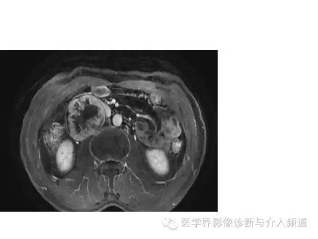 【病例】腹膜后神经鞘瘤2例MR影像表现