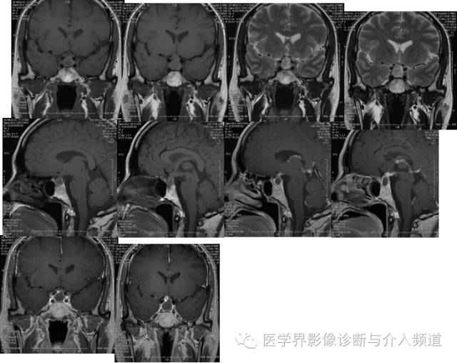 【病例】垂体脓肿1例MR影像表现