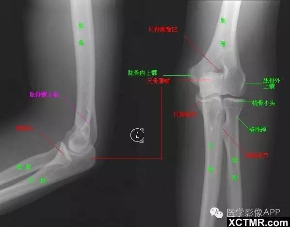 肘关节及前臂骨X线解剖