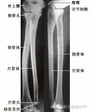 肘关节及前臂骨X线解剖 肘关节及前臂骨X线解剖