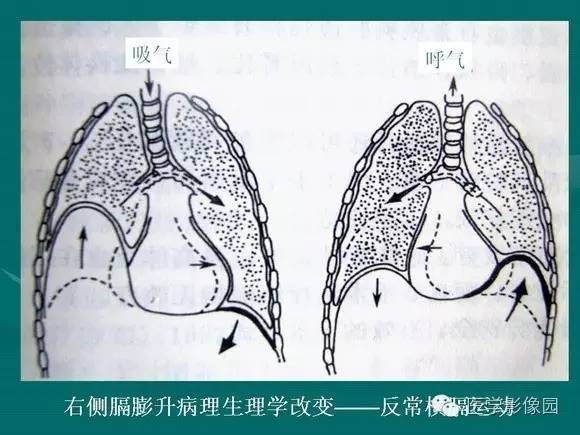 【PPT】膈肌膨出症影像学表现