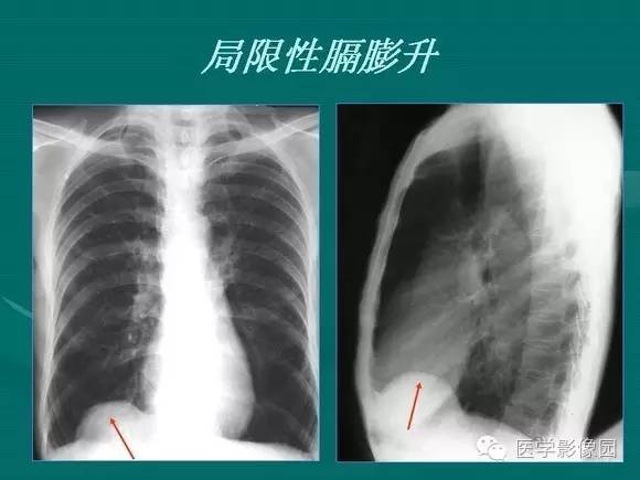 【PPT】膈肌膨出症影像学表现