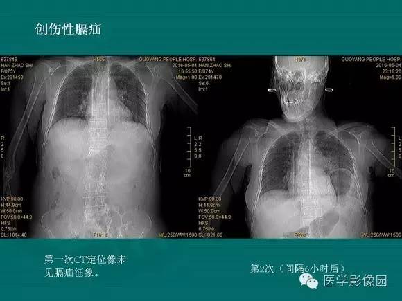 【PPT】膈肌膨出症影像学表现