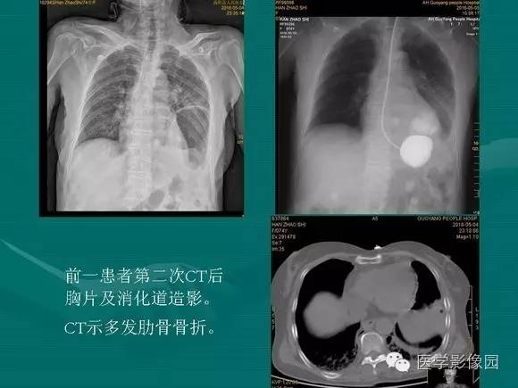 【PPT】膈肌膨出症影像学表现