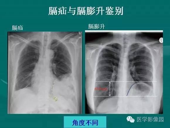 【PPT】膈肌膨出症影像学表现