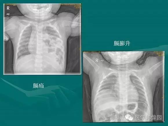 【PPT】膈肌膨出症影像学表现