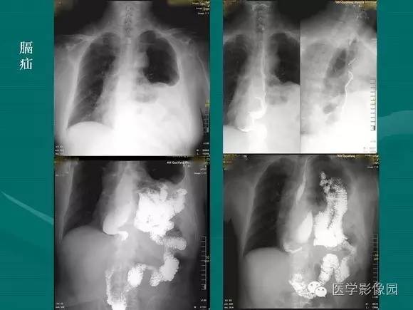 【PPT】膈肌膨出症影像学表现