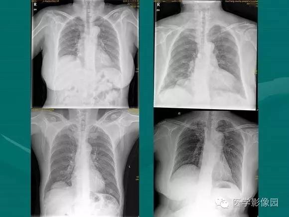 【PPT】膈肌膨出症影像学表现